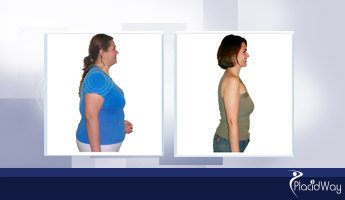 Slider image (7) Cirugia de Obesidad Guatemala - Bariatric Surgery Clinic